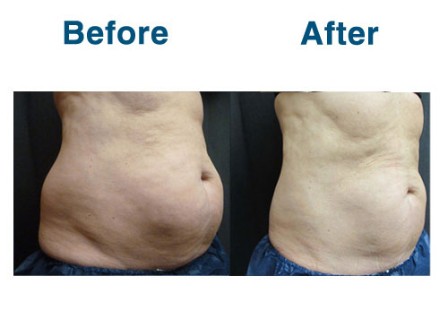 8 weeks Post CoolSculpting (-3 pounds)