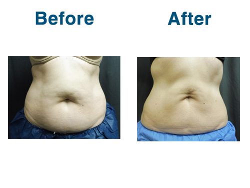 9 weeks Post CoolSculpting (No Weight Change)