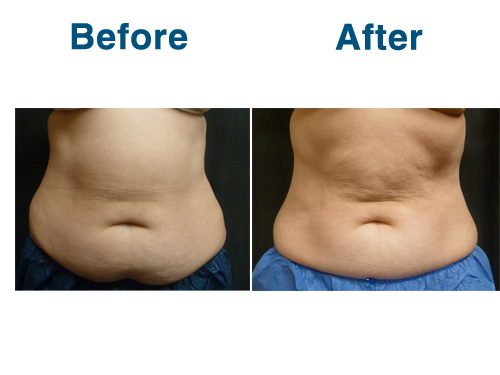 8 week PO from CoolSculpting (+1 pounds)